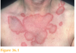 ANNULAR ERYTHEMATOUS RASH OF SUDDEN ONSET