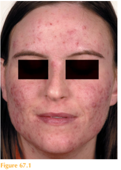 PAPULAR AND PUSTULAR ERUPTION ON THE FACE WITH SCARRING