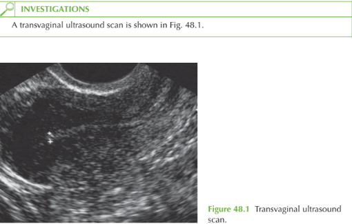 BLEEDING IN EARLY PREGNANCY